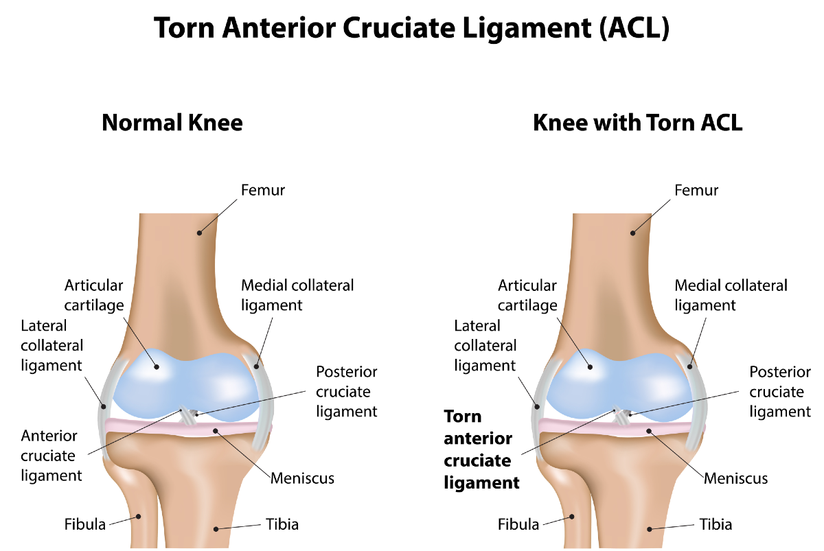 ACL-Tear